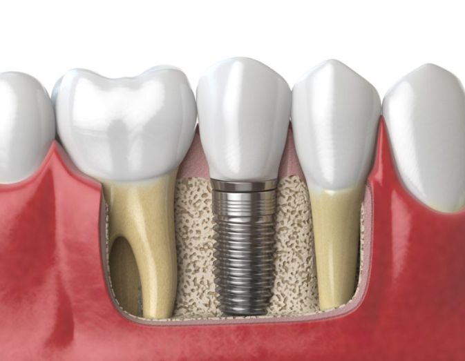 Dental implant